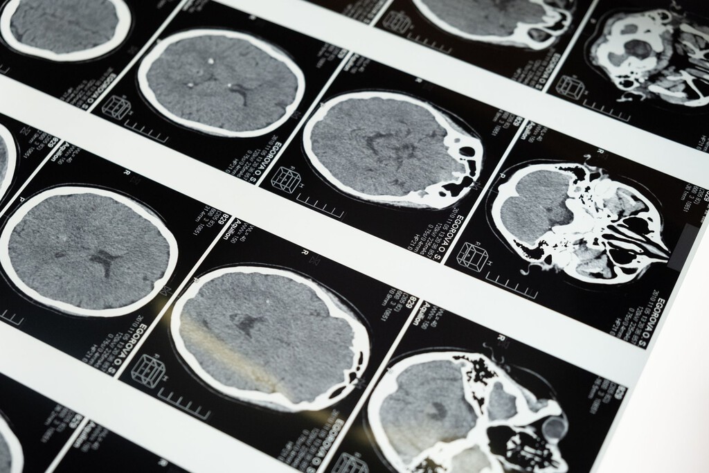 La mala salud metabólica acelera el envejecimiento cerebral a través de una vía independiente de la edad cronológica