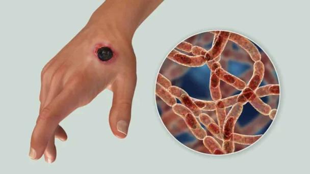 Ántrax: Preocupación por posibles casos en Haití y detalles sobre la enfermedad